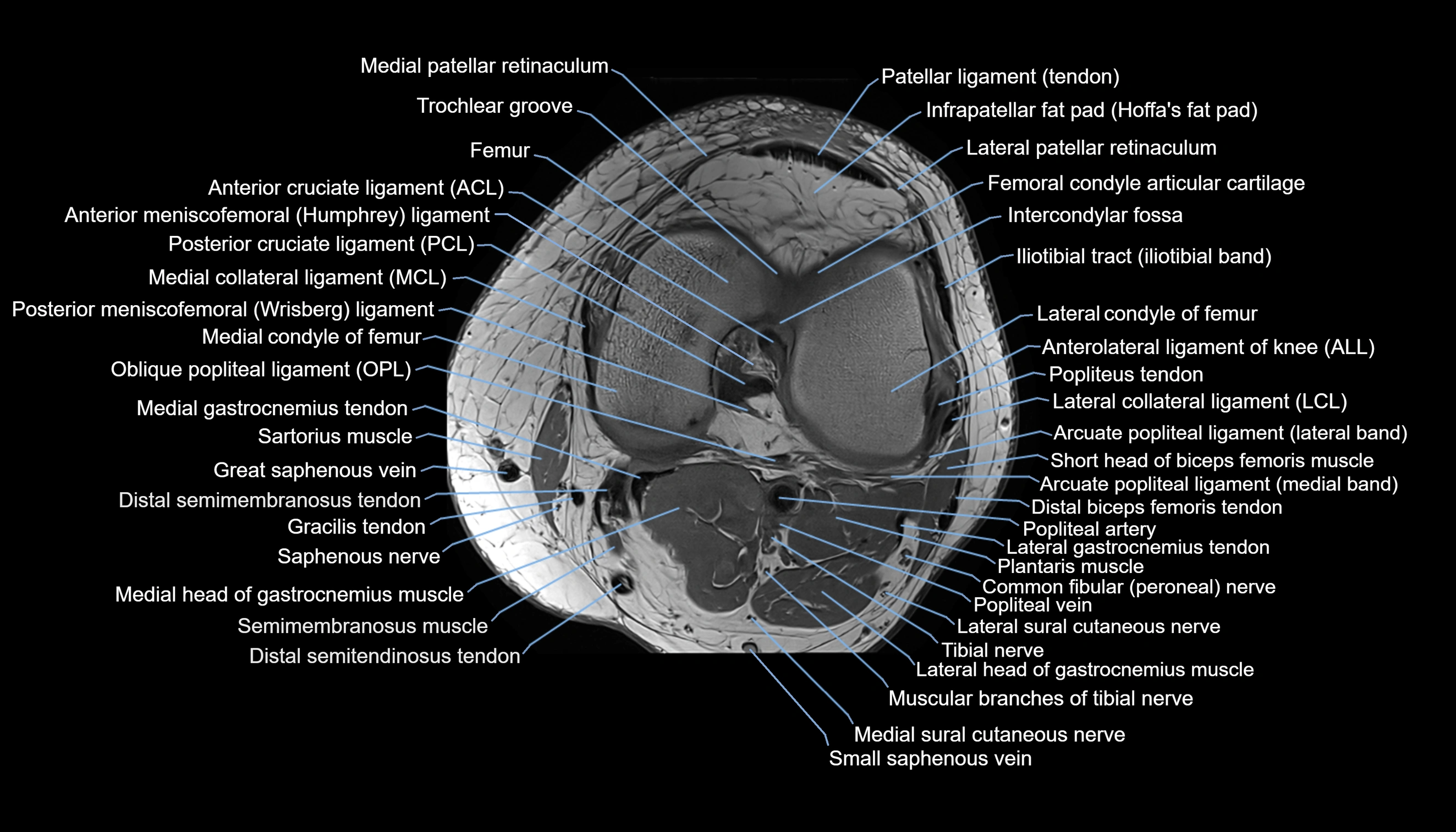 MRI knee  axial cross sectional anatomy 3T radiology  image-img-00001-00026.webp